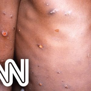 Austrália relata primeiro caso de varíola dos macacos | NOVO DIA